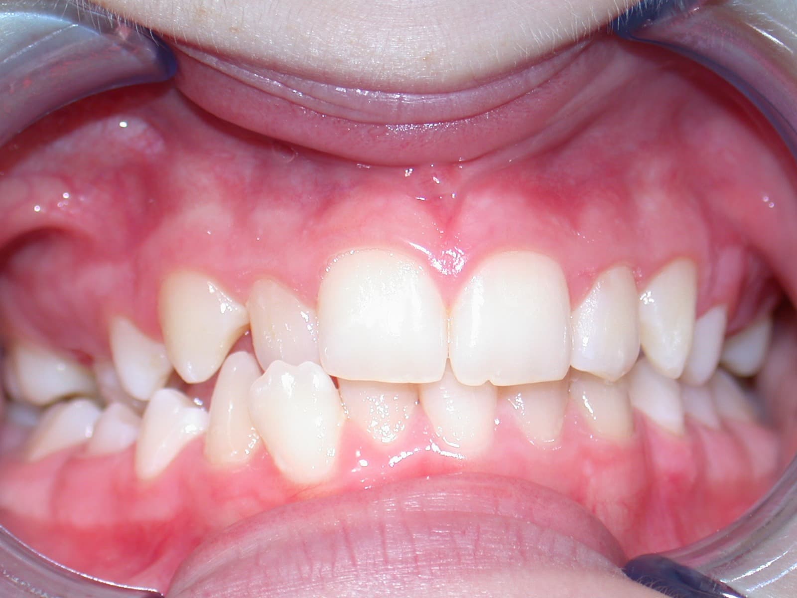 Mid-treatment — Month 2