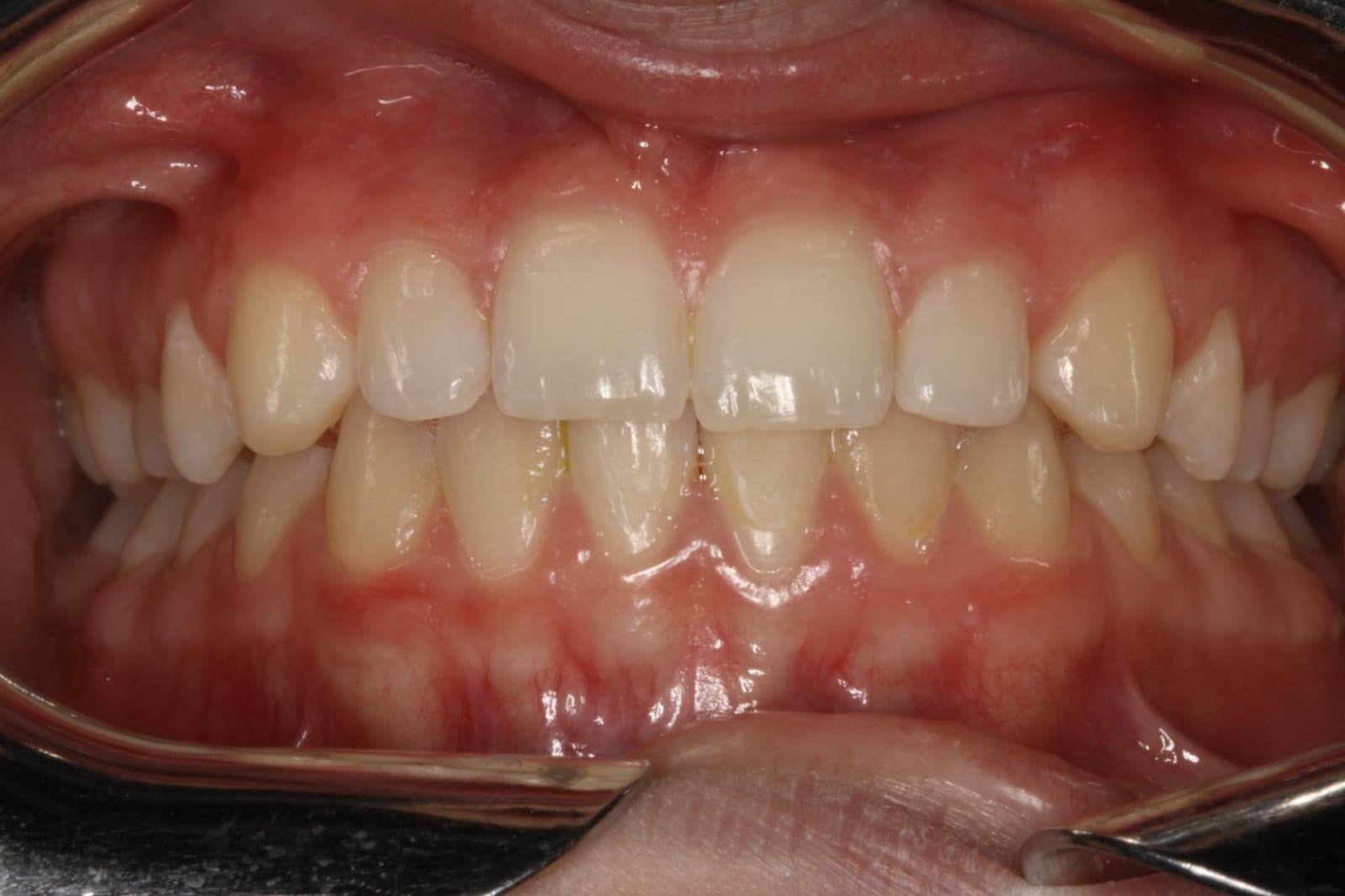 Refinement — Month 4